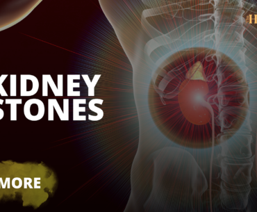 Kidney Stones, The Health Bond